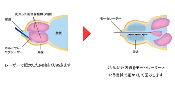 HoLEP治療の手順