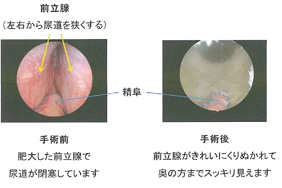 前立腺肥大症の内視鏡写真
